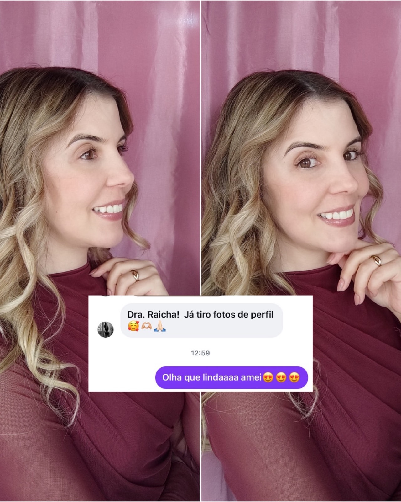 Depois de harmonização facial