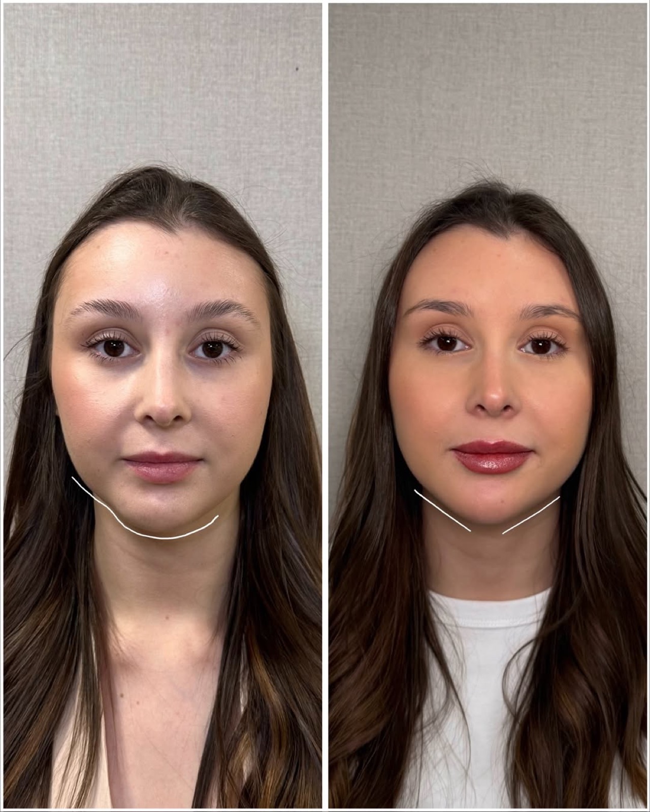 Antes e depois de harmonização facial