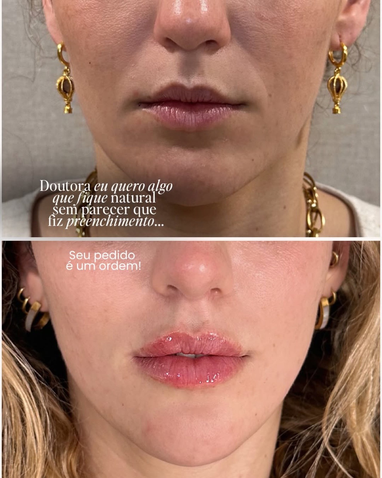 Antes e depois de preenchimento labial