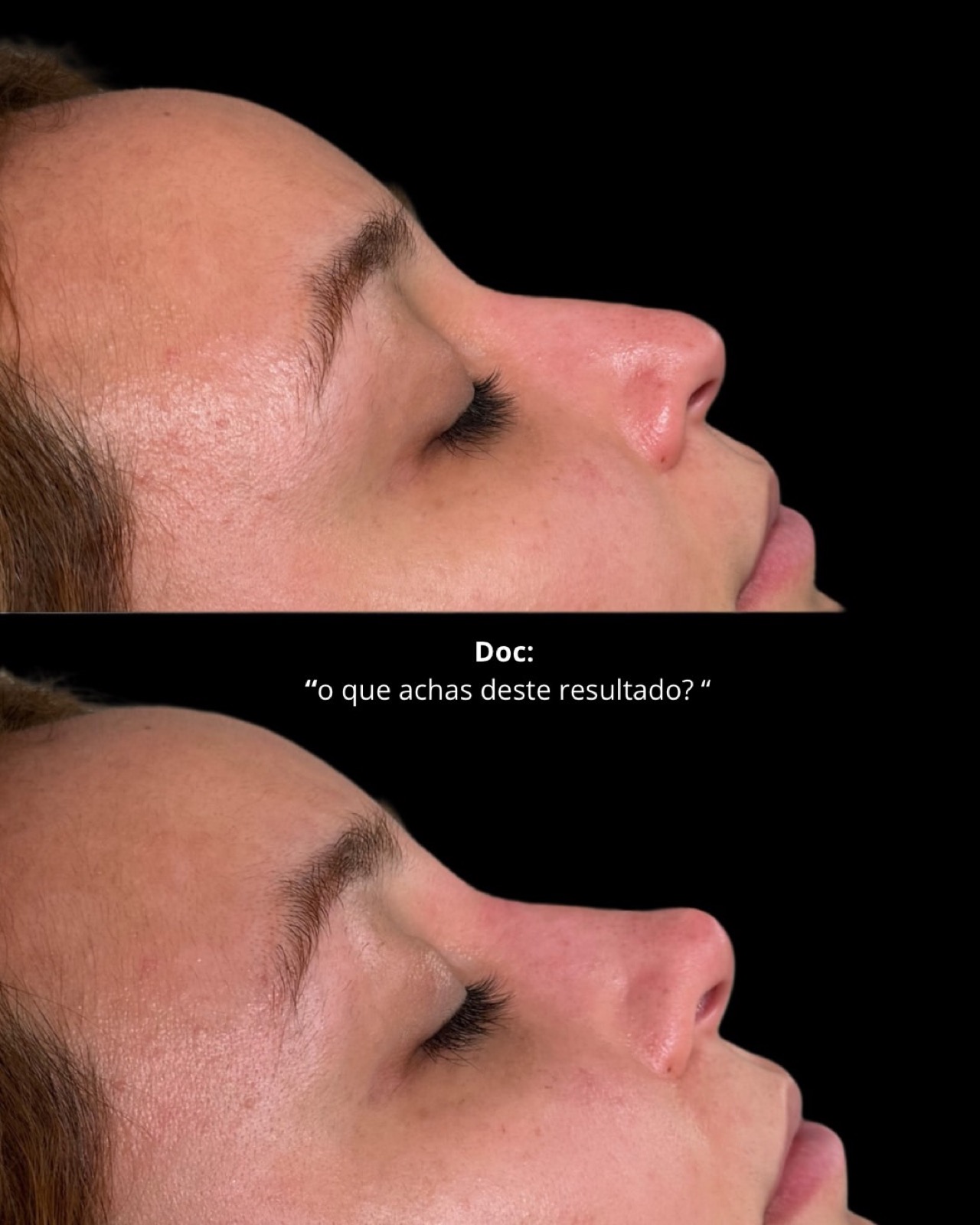 Antes e depois de rinomodelação